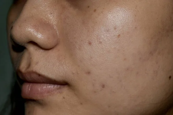 Acne, dark spots and scars on face of Asian young woman.