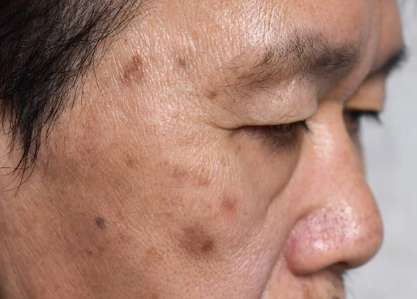 Pequeños Parches Marrones Llamados Manchas Edad Cara Del Anciano Asiático —  Fotos de Stock
