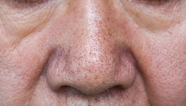 Blackheads Black Heads Nose Asian Old Man Small Bumps Appear — стоковое фото