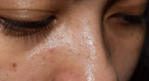 Whiteheads and pimples on oily face of Asian young woman.