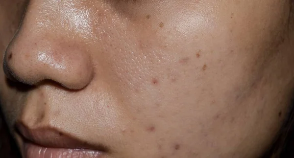 Acne Donkere Vlekken Littekens Het Gezicht Van Aziatische Jonge Vrouw — Stockfoto