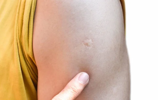 Marca Cicatriz Vacuna Bcg Brazo Del Hombre Del Sudeste Asiático —  Fotos de Stock