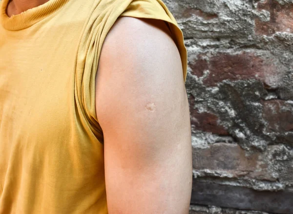 Bcg Vaccine Scar Mark Arm Southeast Asian Man — стоковое фото