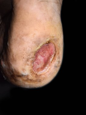 Asyalı bir hastanın ayak ülserinde diyabet. Yakın görünüm.