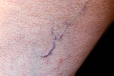 Prominent veins visible through the thin skin of Asian old woman.