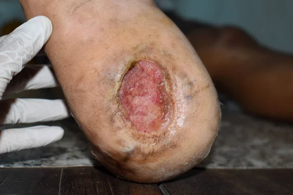Asyalı bir hastanın ayak ülserinde diyabet. Yakın görünüm.