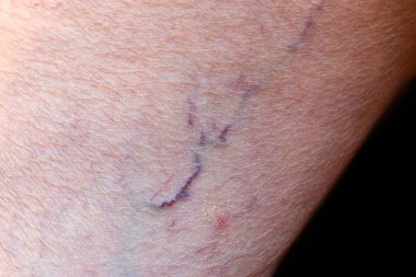 Prominent veins visible through the thin skin of Asian old woman.
