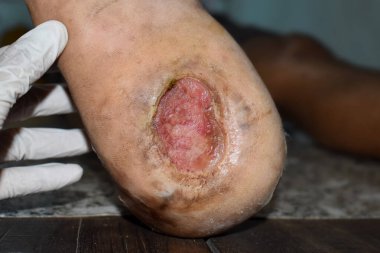 Asyalı bir hastanın ayak ülserinde diyabet. Yakın görünüm.