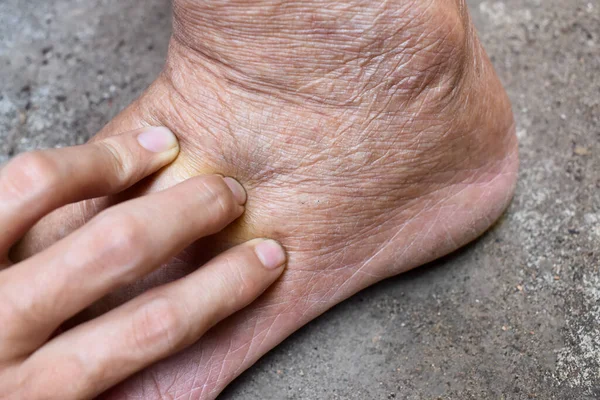 Διόγκωση Οιδήματος Κάτω Άκρου Πρησμένο Πόδι Ασιάτη Γέρου — Φωτογραφία Αρχείου