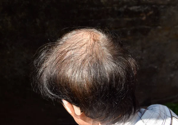 Thinning Sparse Hair Male Pattern Hair Loss Southeast Asian Chinese — Stock Photo, Image