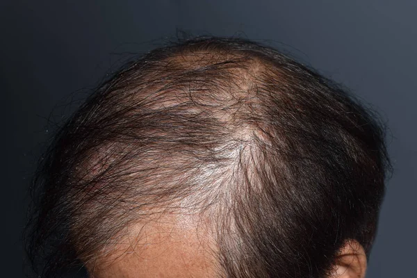 Thinning or sparse hair, male pattern hair loss in Southeast Asian, Chinese elder man.