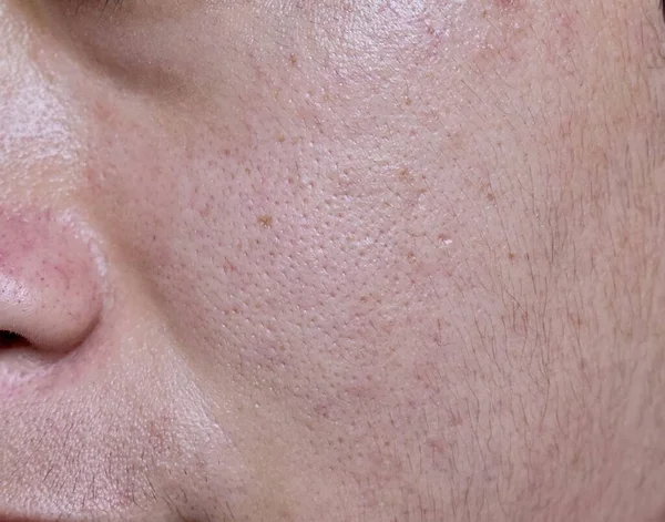 Fair skin with wide pores in face of Southeast Asian, Myanmar or Korean adult young man.