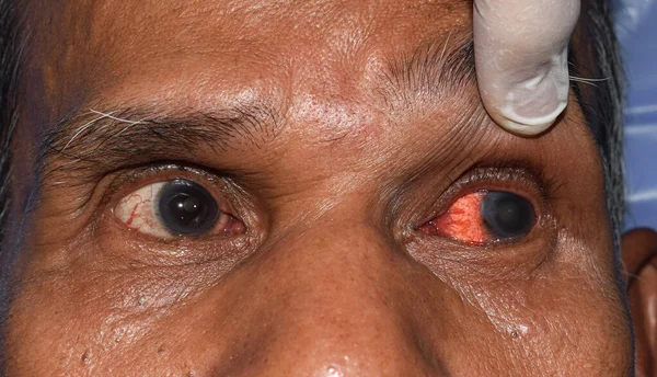 Corneal Infection Ulcer Called Keratitis Asian Old Man — Fotografia de Stock