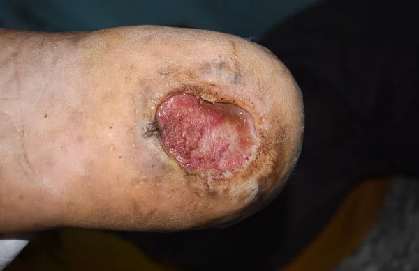 Ulcera Del Piede Del Diabete Piedi Del Paziente Asiatico Vista — Foto Stock