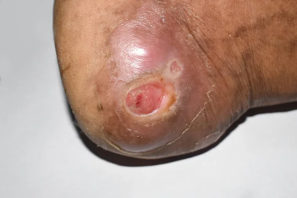 Diabetes Fußgeschwür Fuß Eines Asiatischen Patienten Nahaufnahme — Stockfoto