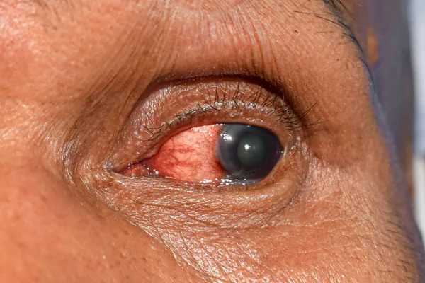 Corneal Infection Ulcer Called Keratitis Asian Old Woman — Fotografia de Stock