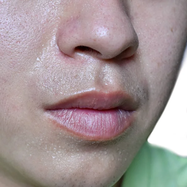 Excessive sweating or hyperhidrosis and oily skin at face of Southeast Asian, Myanmar or Chinese adult young man. Oily skin is the result of overproduction of sebum from sebaceous glands.