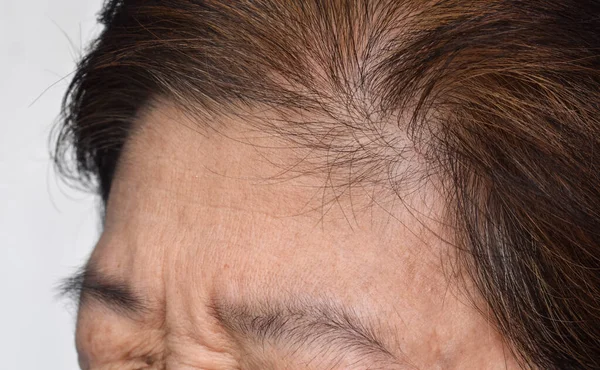 Skin Creases Wrinkles Forehead Southeast Asian Myanmar Burmese Elder Woman — Stock Photo, Image