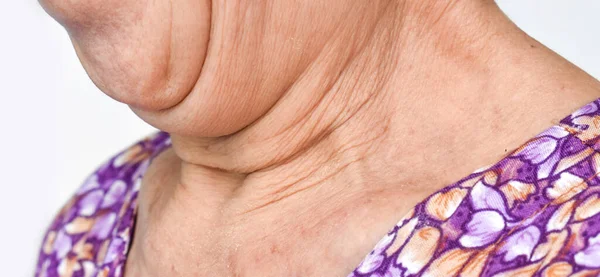 Envelhecimento Dobras Pele Vincos Pele Rugas Pescoço Bolso Gordura Sudeste — Fotografia de Stock