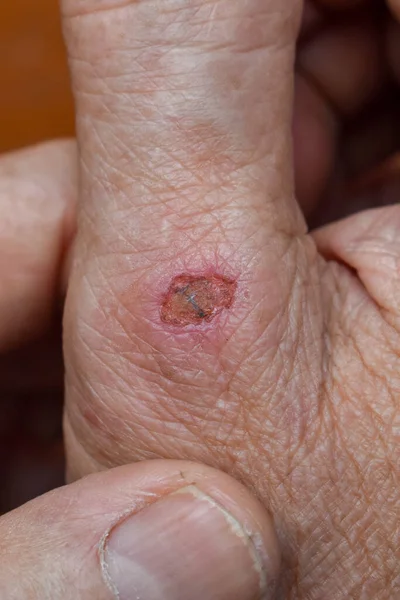 Infecção Bacteriana Ferida Traumática Infectada Mão Homem Mais Velho Asiático — Fotografia de Stock