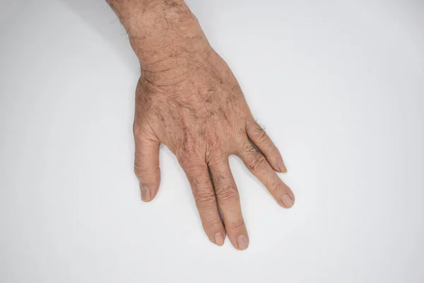 痉挛的手 手部肌肉痉挛 手部保健的概念 — 图库照片