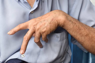Asyalı yaşlı adamın Ulnar pençesi. Ayrıca evde kalmış pençe olarak da bilinir. Kol kemiği zedelenmesi, bel kemiğinin zayıflamasına neden olur..