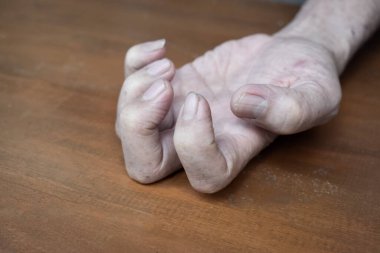 Güneydoğu Asyalı yaşlı bir adamın sol üst bacağında Volkmann kasılması. El, el, parmak ve bilek pençe benzeri bir duruş oluşturan ön kol kaslarının sürekli kısaltılmasıdır..