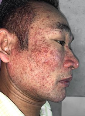 Acute itching red lesions like severe acnes over whole face of Southeast Asian man. Acne occurs when hair follicles become plugged with oil and dead cells. It causes whiteheads, blackheads or pimples.