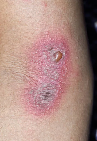 Dermatitis Paederus Brazo Contacto Peculiar Irritante Causado Por Escarabajo Perteneciente — Foto de Stock