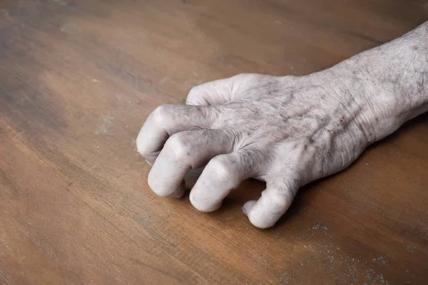 東南アジアの老人の左上肢のフォルクスマンの収縮 手首のような姿勢を生み出す永久的な前腕の筋肉の短縮です — ストック写真