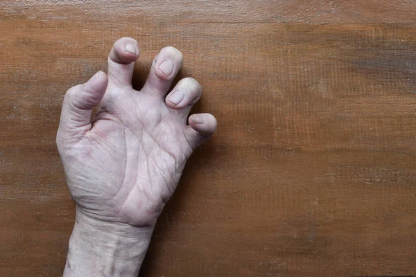 Volkmann contracture in left upper limb of Southeast Asian elder man. It is a permanent shortening of forearm muscles that gives rise to a clawlike posture of the hand, fingers, and wrist.