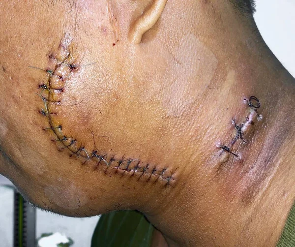 Non Absorbable Nylon Sutures Large Wound Left Cheek Silk Stitches — Stok Foto