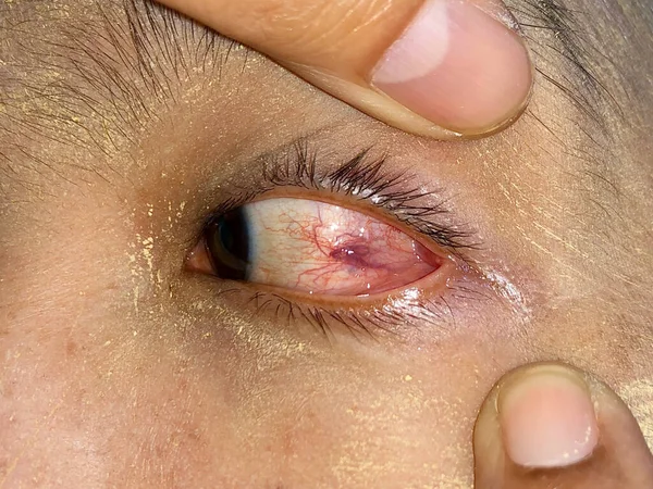 Ocular Larva Migrans Dilated Vessels Left Eye Southeast Asian Man — Photo