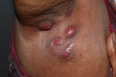 Asyalı Birmanyalı kadın hastaların aksillasında büyük yakut ya da apse var..