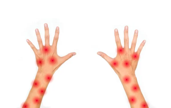 Monkeypox Skin Rashes Both Arms Asian Young Man Isolated White — Stock Photo, Image