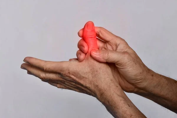 Entzündung Des Daumens Und Der Hand Des Asiatischen Alten Mannes — Stockfoto