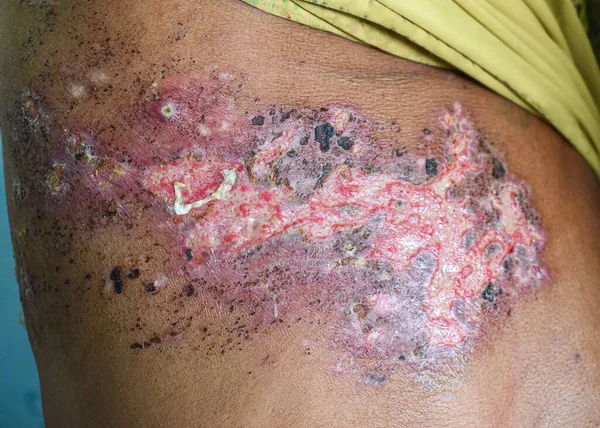 Herpes Simplex Infektion Brust Und Bauch Des Asiatischen Mannes — Stockfoto