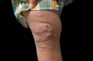 Scabies Infestation with secondary or superimposed bacterial infection and pustules in leg of Southeast Asian, Burmese child. clipart