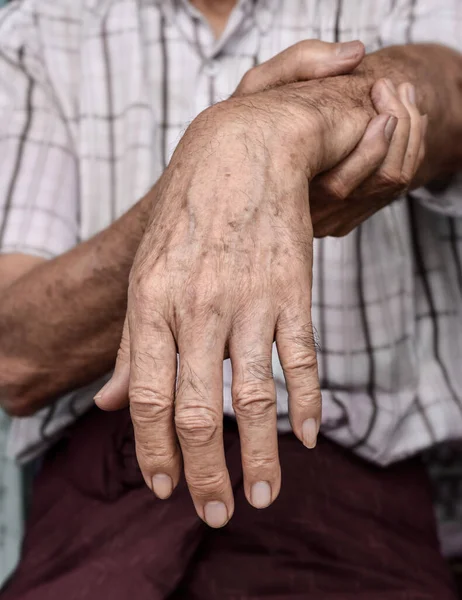 Lésion Nerveuse Radiale Chute Poignet Homme Asiatique Myanmar — Photo