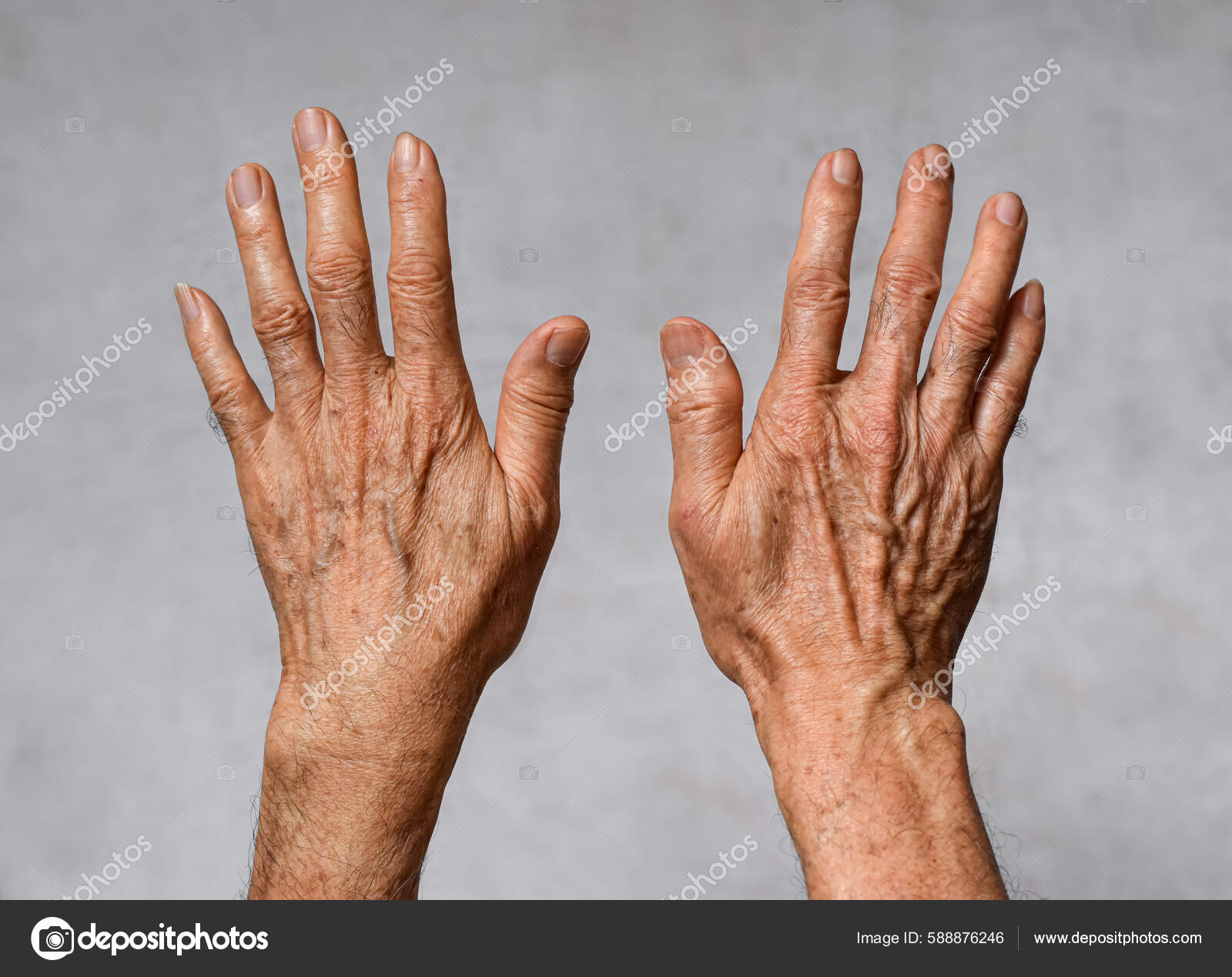 An Elderly Man S Hand With And Some Black Spots Background, Picture Of Skin  Cancer On Fingers, Cancer, Tumor Background Image And Wallpaper for Free  Download