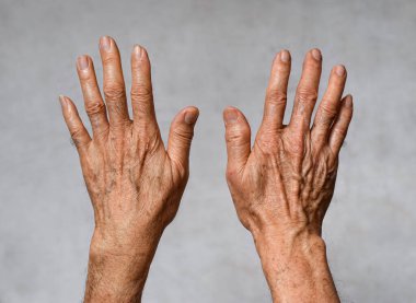 Asyalı yaşlı adamın ellerinde yaş lekeleri var. Bunlar kahverengi, gri veya siyah noktalardır ve ayrıca karaciğer lekeleri, bunak mercimek, güneş mercimeği veya güneş lekeleri olarak da adlandırılır..