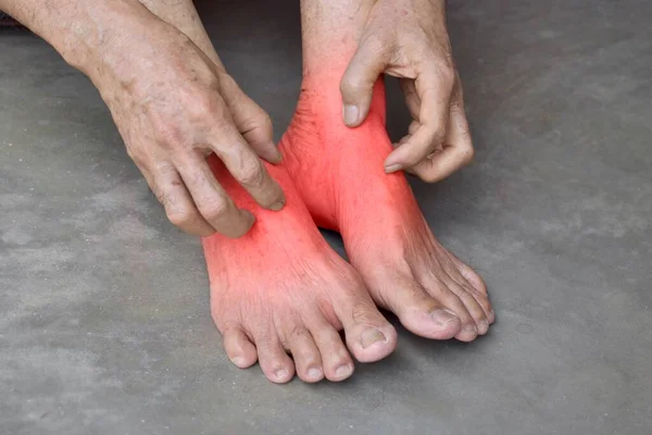 Asian Elder Man Scratching His Foot Concept Itchy Skin Diseases — 스톡 사진