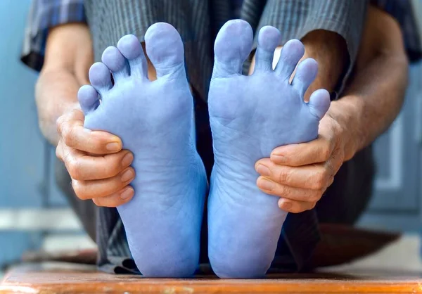 Světle Modré Nohy Asijského Staršího Muže Koncept Studené Neohrabané Nohy — Stock fotografie