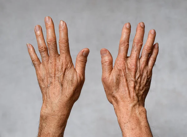 Åldersfläckar Händerna Asiatisk Äldre Man Bruna Grå Eller Svarta Fläckar — Stockfoto