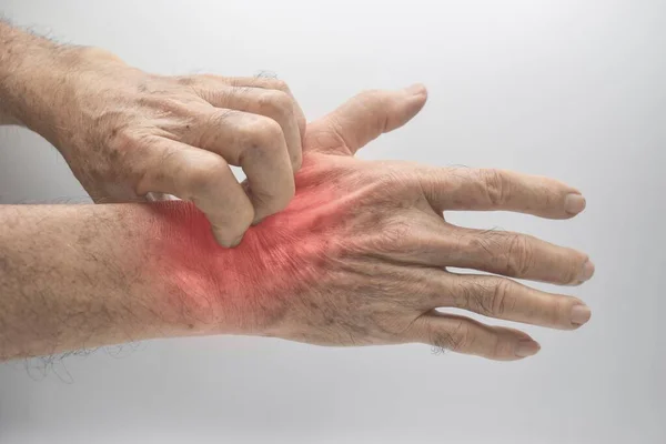 Asian Elder Man Scratching His Hand Concept Itchy Skin Diseases — Φωτογραφία Αρχείου