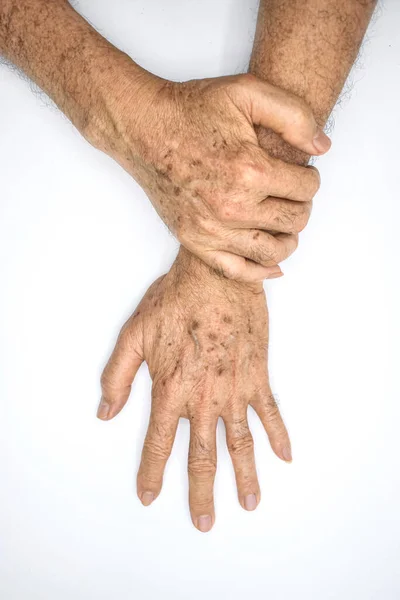 Åldersfläckar Händerna Asiatisk Äldre Man Bruna Grå Eller Svarta Fläckar — Stockfoto