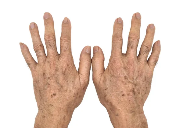 Manchas Idade Nas Mãos Homem Mais Velho Asiático São Manchas — Fotografia de Stock