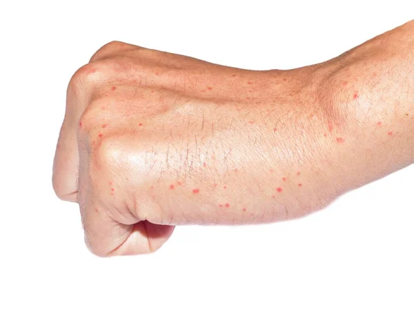 Mehrere Juckende Stechmücken Oder Insektenstiche Rote Flecken Auf Der Hand — Stockfoto