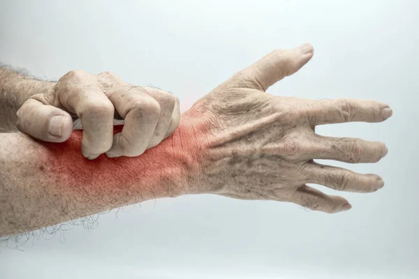 Asian Elder Man Scratching His Forearm Concept Itchy Skin Diseases — Stockfoto