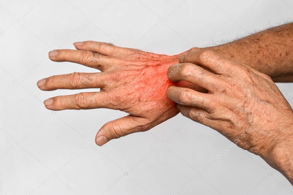 Asian elder man scratching his hand. Concept of itchy skin diseases such as scabies, fungal infection, eczema, psoriasis, allergy, etc.